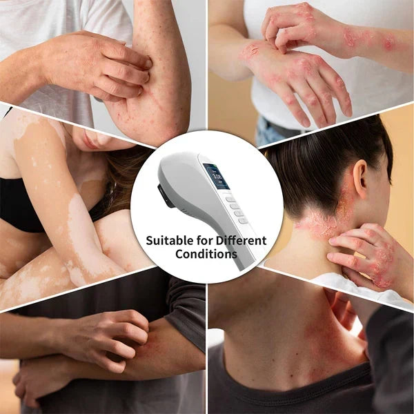 Tratamiento de psoriasis y vitíligo con dispositivo UVB 308nm casero. Terapia de luz portátil.