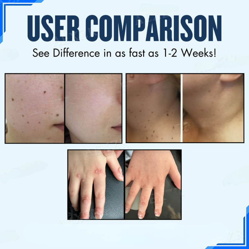 Tratamiento dermatológico con parches para reducir verrugas e imperfecciones. Cuidado facial avanzado.