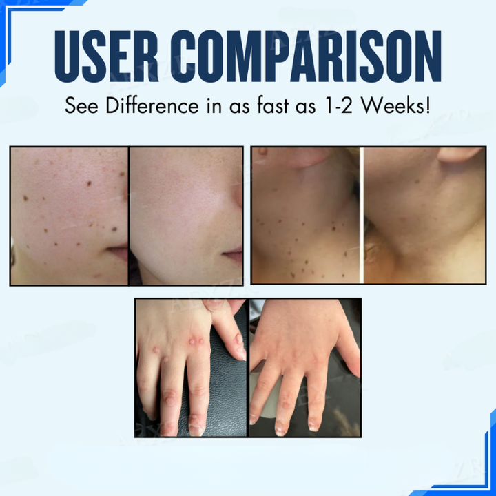 Tratamiento dermatológico con parches para reducir verrugas e imperfecciones. Cuidado facial avanzado.