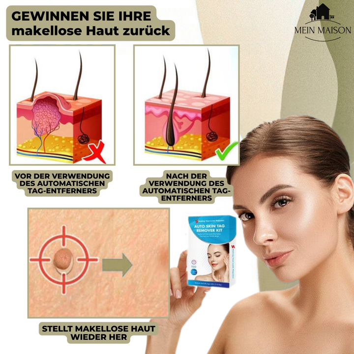 Empaque del removedor de verrugas y lunares sin dolor. Solución de belleza y cuidado de la piel para el hogar.