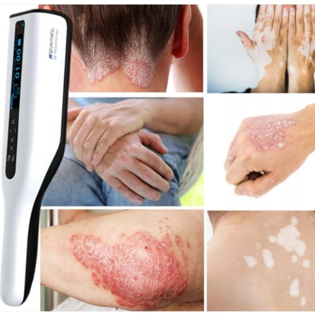 Usuario aplicando lámpara UVB portátil en la mano. Cuidado preciso para psoriasis y vitíligo localizado.