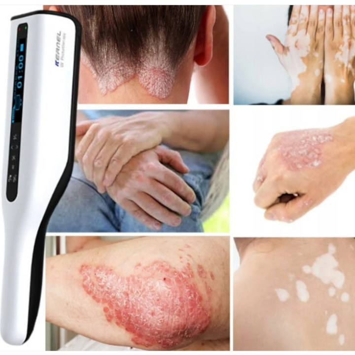 Usuario aplicando lámpara UVB portátil en la mano. Cuidado preciso para psoriasis y vitíligo localizado.