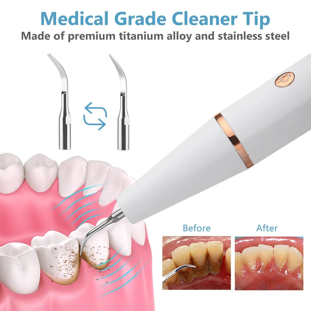 Dispositivo ultrasónico de limpieza dental en uso, eliminando sarro y placa para dientes más blancos.