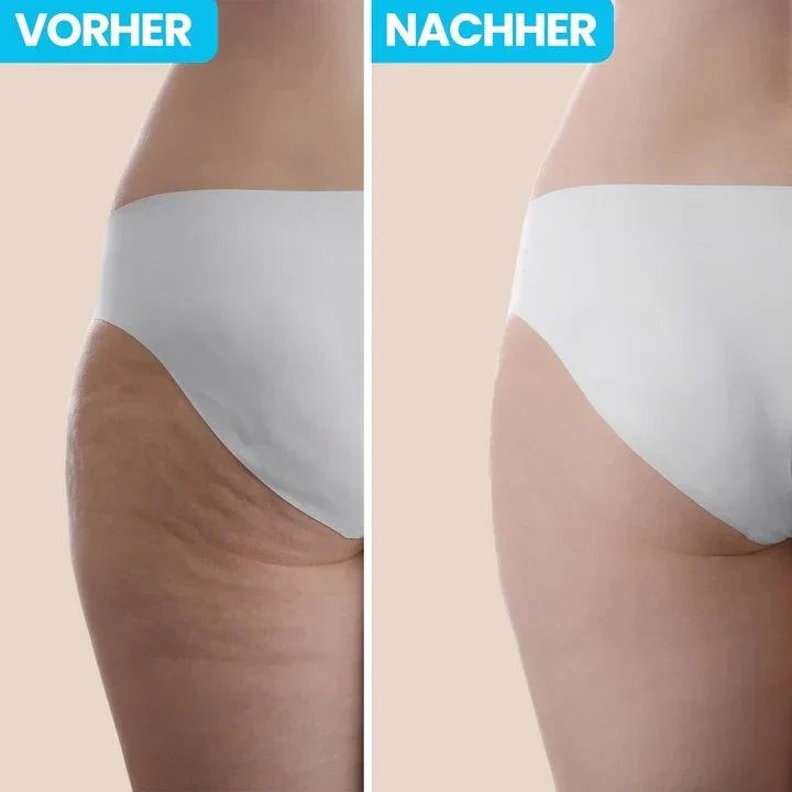 Diseño ergonómico del masajeador anticelulítico. Fácil de usar para una piel suave y sin celulitis.