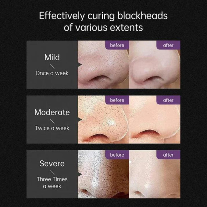 Set de extractores de comedones y herramientas para acné, esenciales para la belleza y limpieza facial.