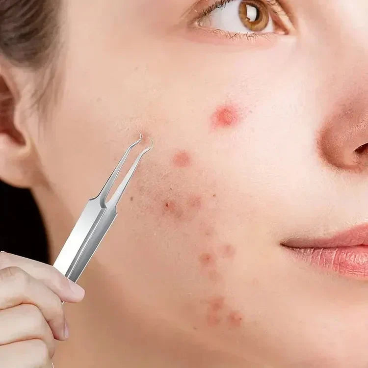 Herramientas de extracción de puntos negros de acero inoxidable para cuidado facial duradero.