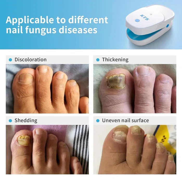 Tecnología láser dual para un cuidado óptimo de uñas, luz azul y ultrapulso.