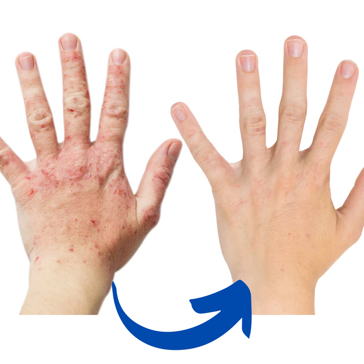Alivio efectivo del dolor de manos con guantes de terapia infrarroja para artritis y fisioterapia.