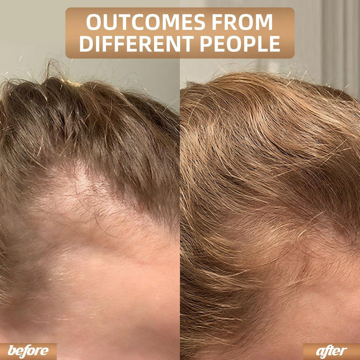 Solución capilar REGENVIE Pro para un cabello sano, fuerte y denso. Crecimiento, anti-caída y regeneración.