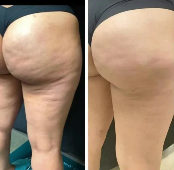 Tratamiento de aceite masaje anticelulítico para piel firme, suave y elasticidad mejorada. Reduce la celulitis.