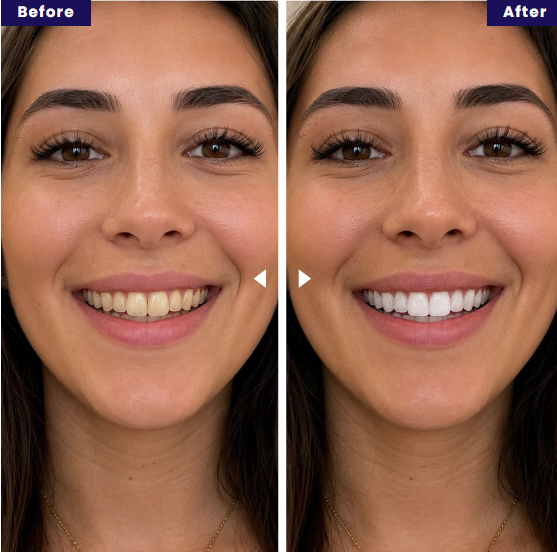 Sonrisa brillante con dientes blancos tras usar tiras blanqueadoras PAP Púrpura. Blanqueamiento dental efectivo.