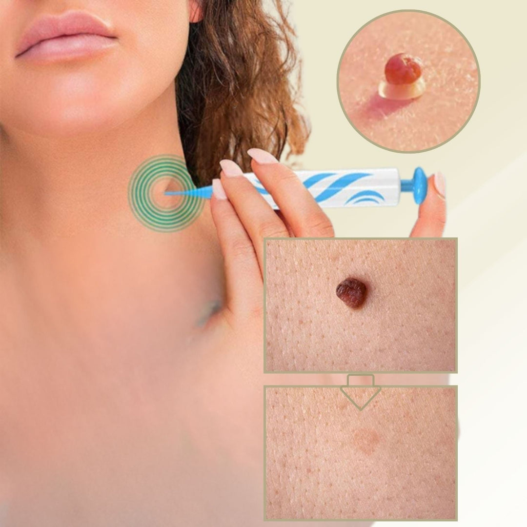 Removedor de verrugas y lunares sin dolor para uso casero. Tratamiento efectivo para piel suave y sin imperfecciones.