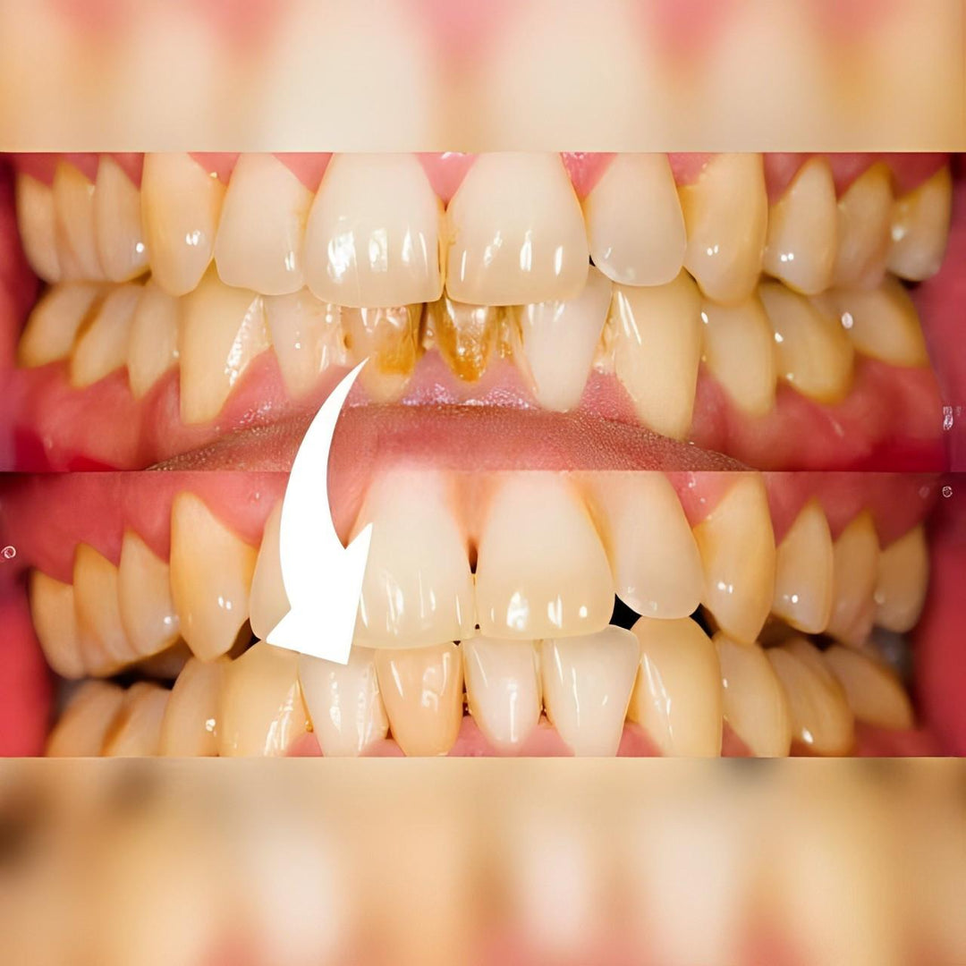 Logra dientes blancos y una sonrisa radiante con este escalador dental profesional para limpieza profunda.