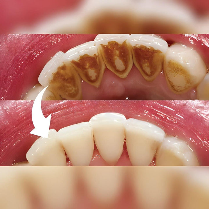 Escalador dental profesional para un cuidado bucal completo. Herramienta esencial para una higiene oral avanzada.
