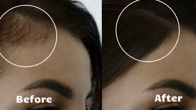 Dispositivo anti-caída capilar con terapia de luz. Fortalece el cabello y mejora la salud del cuero cabelludo.