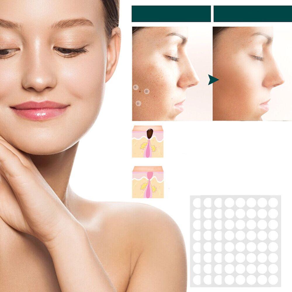 Parches cutáneos SkinClear: antes y después de verrugas. Tratamiento eficaz para una piel suave, bella y sin dolor.
