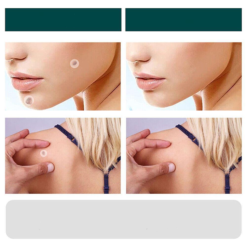 Parches SkinClear de hidrocoloide para verrugas. Cuidado facial y corporal avanzado, discreto y sin dolor para piel.