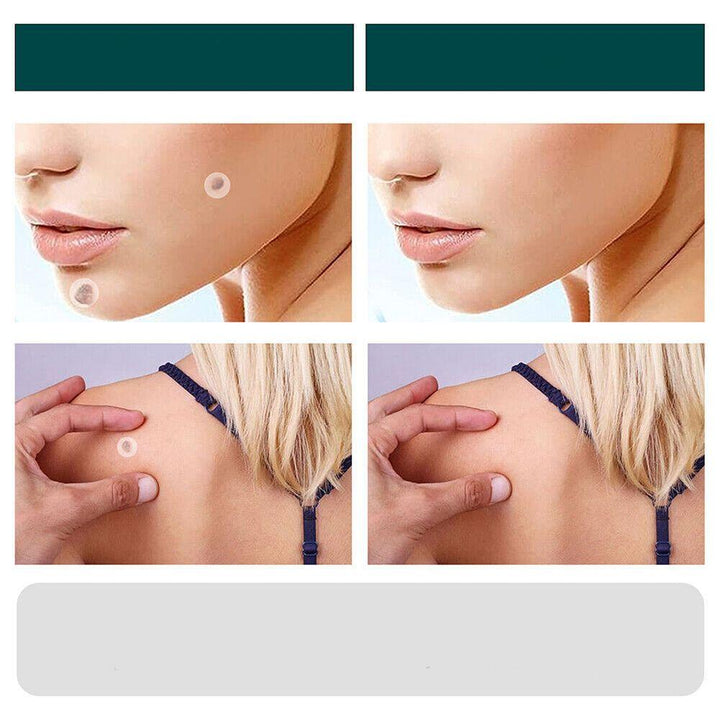 Parches SkinClear de hidrocoloide para verrugas. Cuidado facial y corporal avanzado, discreto y sin dolor para piel.