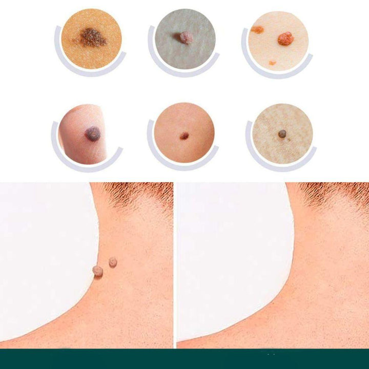 Parche eliminador SkinClear aplicado en piel. Discreto y sin dolor, trata verrugas y fibromas. Para una piel suave.