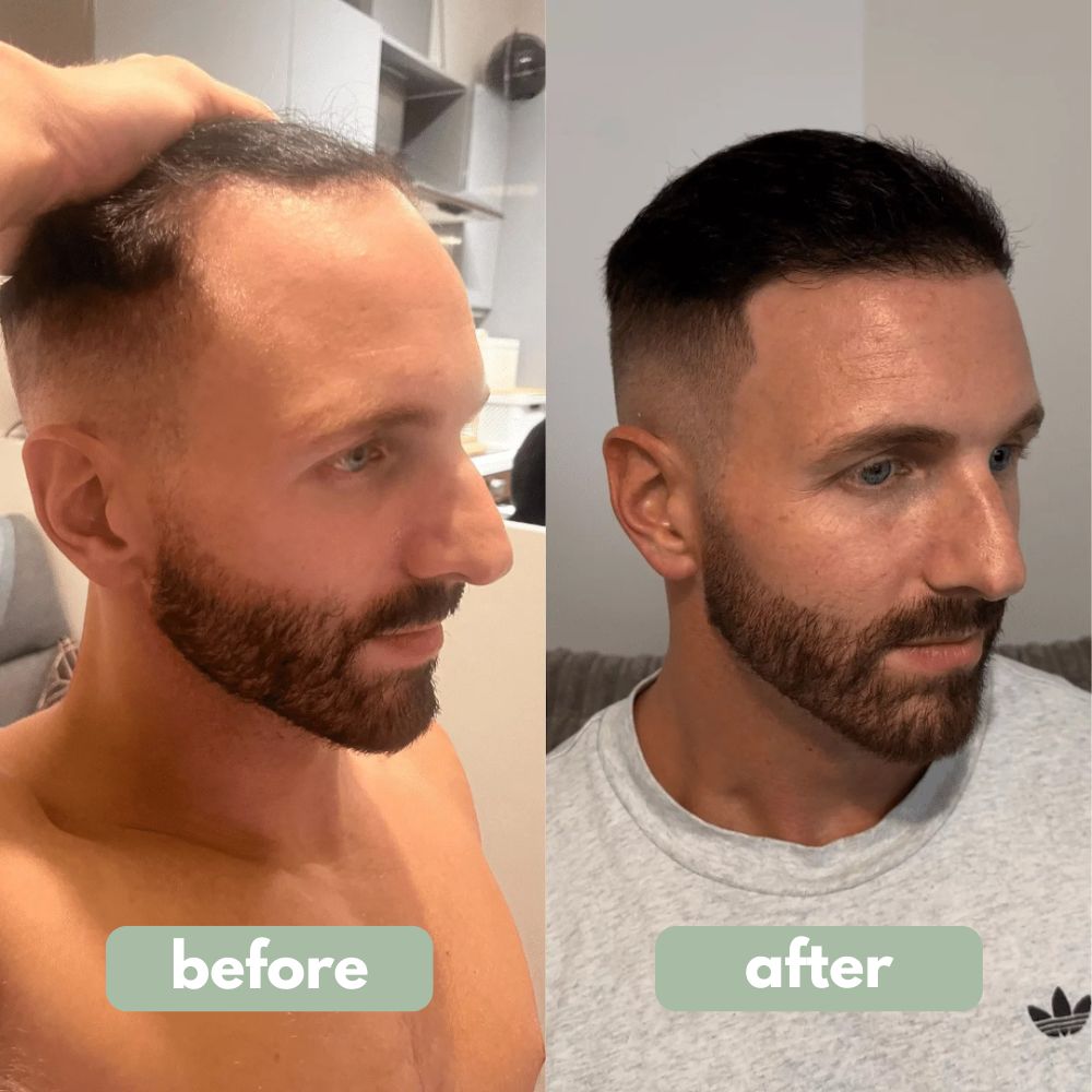 Serum capilar pro-crecimiento con Redensyl, Anagain, Aminexil y romero. Tratamiento fortalecedor anticaída.