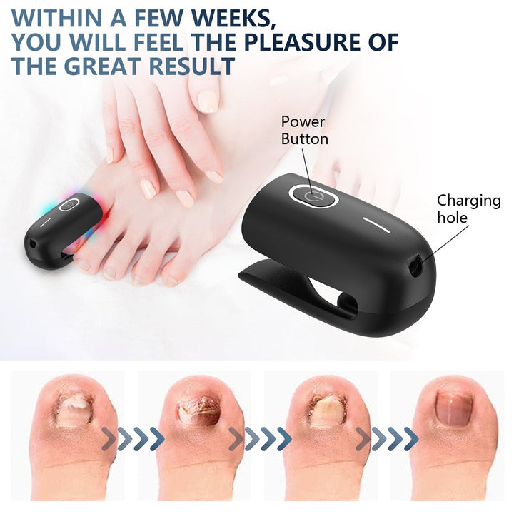 Kit de tratamiento láser para hongos en uñas: dispositivo, cable USB y manual. Salud y cuidado pies.