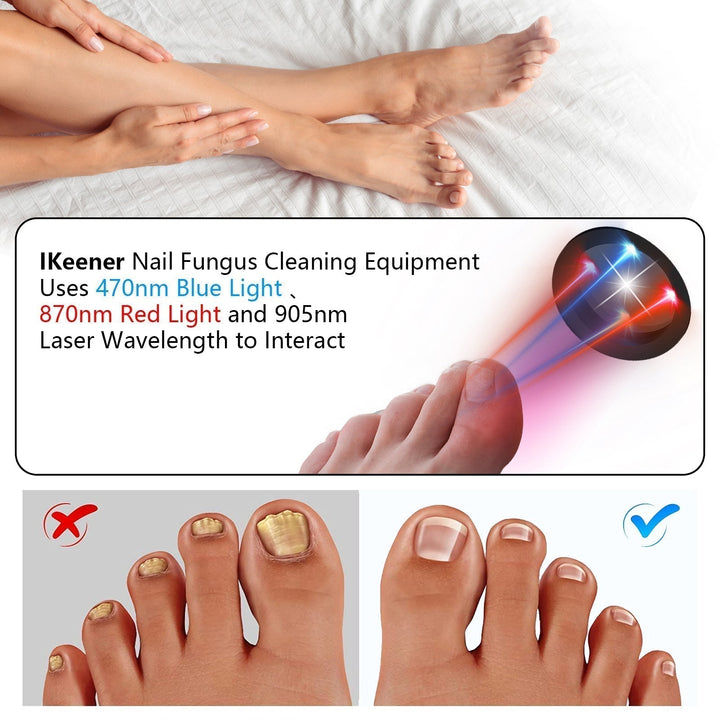 Dispositivo láser para hongos en uñas en su empaque original. Tratamiento onicomicosis, recargable.