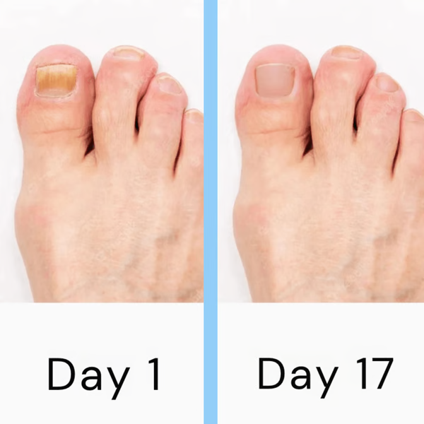 Tecnología láser avanzada para el cuidado y eliminación de hongos en uñas, mejora la belleza y salud.