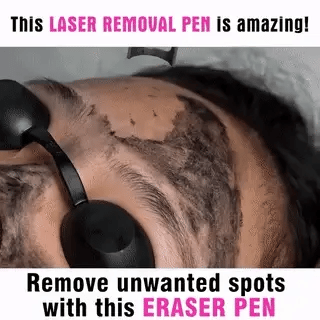 Dispositivo láser picosegundos eficaz para eliminación de manchas solares, pecas y pigmentación facial.