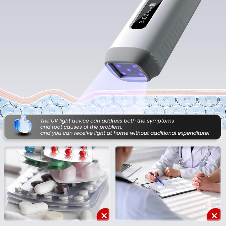 Aparato UVB 308nm para cuero cabelludo con alopecia. Terapia de luz casera para salud piel.