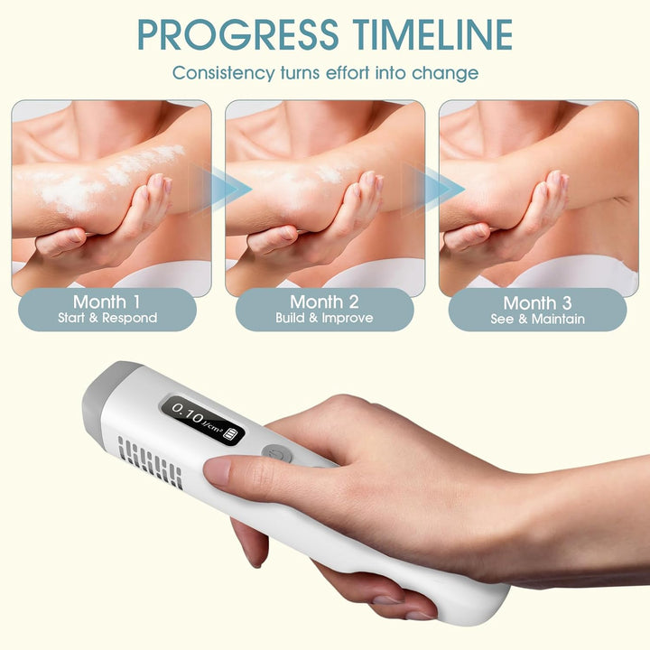 Persona usando dispositivo fototerapia UVB 308nm en la piel. Terapia luz psoriasis, vitiligo.