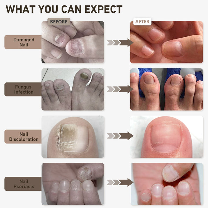 Mejora la salud y estética de tus uñas con este dispositivo LED de terapia de luz para manos y pies.