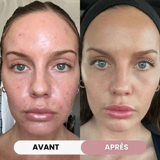 Dispositivo de belleza facial para cuidado de la piel, reduciendo arrugas y líneas finas con luz LED.