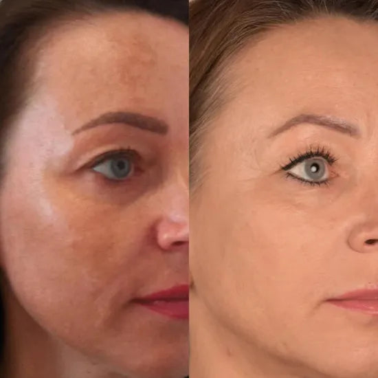 Aparato anti-edad con tecnología EMS y luz LED para masaje facial y reafirmación de la piel.