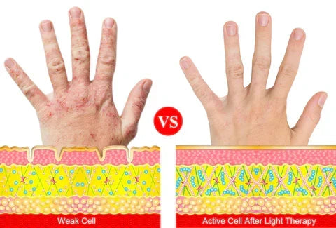 Uso doméstico de guantes de terapia infrarroja, cuidando la salud de manos con artritis.